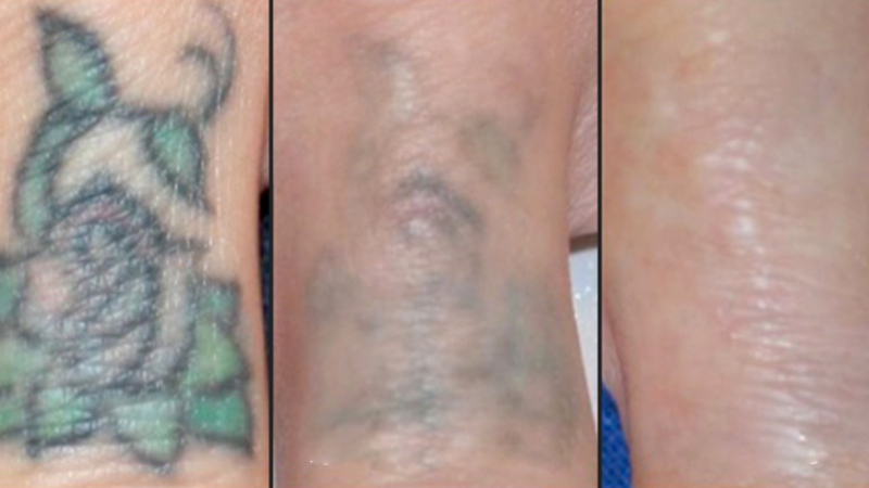 Удаление татуировки лазером: особенности и результаты процедуры